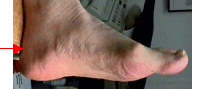The image displays a close-up of a person s foot with visible bunions and corns, which are common skin conditions that can cause discomfort or pain.