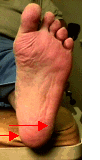 The image shows a person s lower leg with a noticeable swollen ankle and a foot with a large, red-looking sore on the bottom.