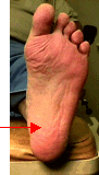 An image of a person s foot with a noticeable red rash or lesion on the sole, displayed in a close-up view against a neutral background.