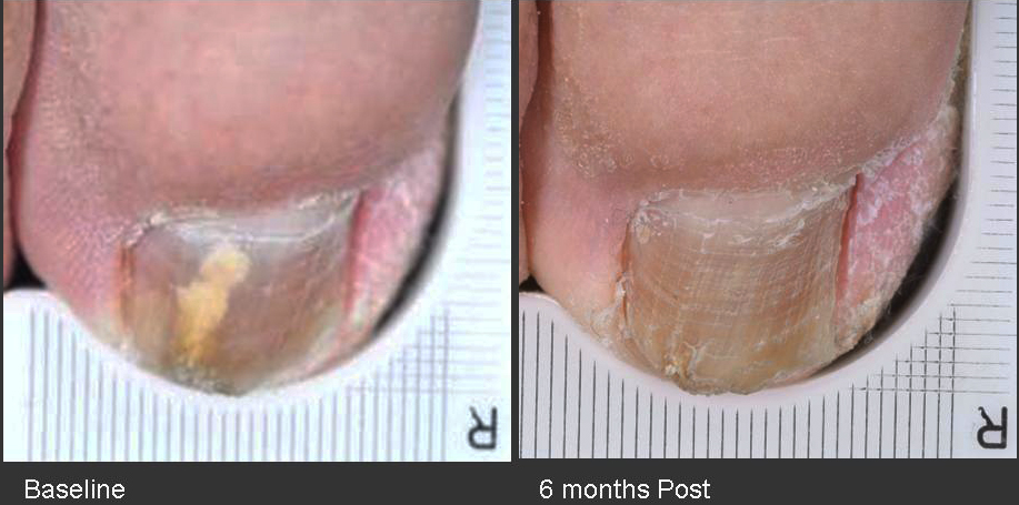 The image shows a side-by-side comparison of two feet with different nail conditions, one with a healthy toenail and the other with an unhealthy one.
