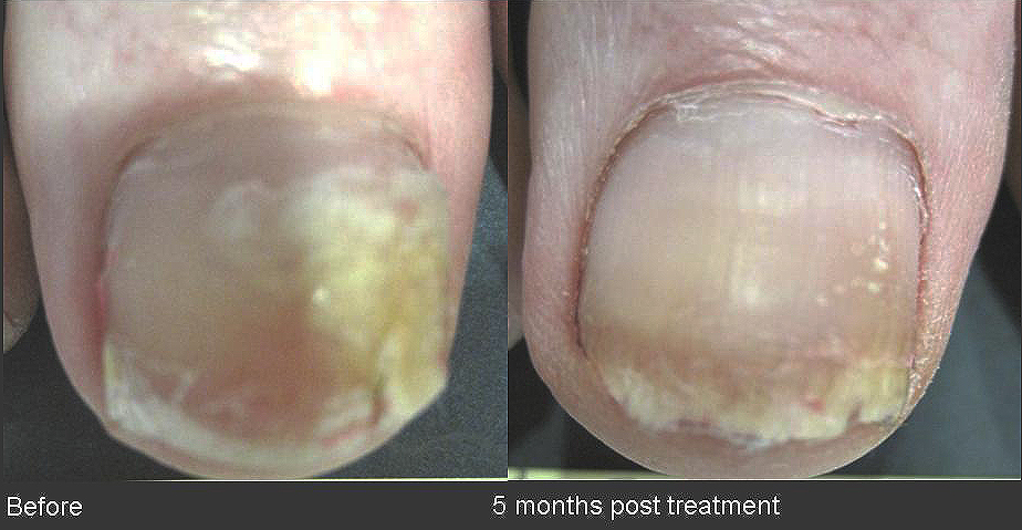 The image shows a close-up of a person s foot with a damaged toenail, before and after treatment, highlighting the improvement achieved by nail care or medical intervention.