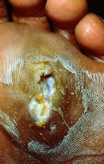 The image shows a foot with a large, open sore on the bottom, which appears to be infected and in need of medical attention.